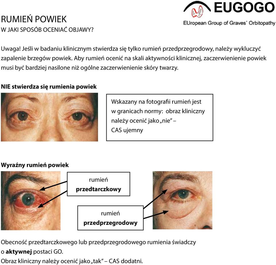 NIE stwierdza się rumienia powiek Wskazany na fotografii rumień jest w granicach normy: obraz kliniczny należy ocenić jako nie CAS ujemny Wyraźny rumień