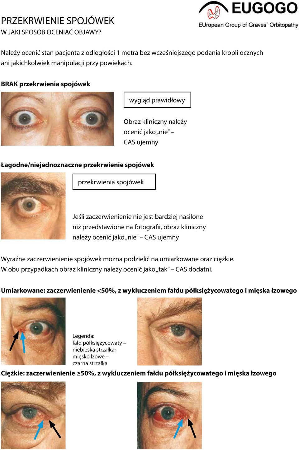 bardziej nasilone niż przedstawione na fotografii, obraz kliniczny należy ocenić jako nie CAS ujemny Wyraźne zaczerwienienie spojówek można podzielić na umiarkowane oraz ciężkie.