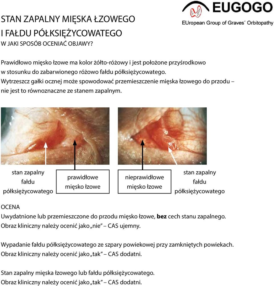 stan zapalny fałdu półksiężycowatego prawidłowe mięsko łzowe nieprawidłowe mięsko łzowe stan zapalny fałdu półksiężycowatego OCENA Uwydatnione lub przemieszczone do przodu mięsko łzowe, bez cech