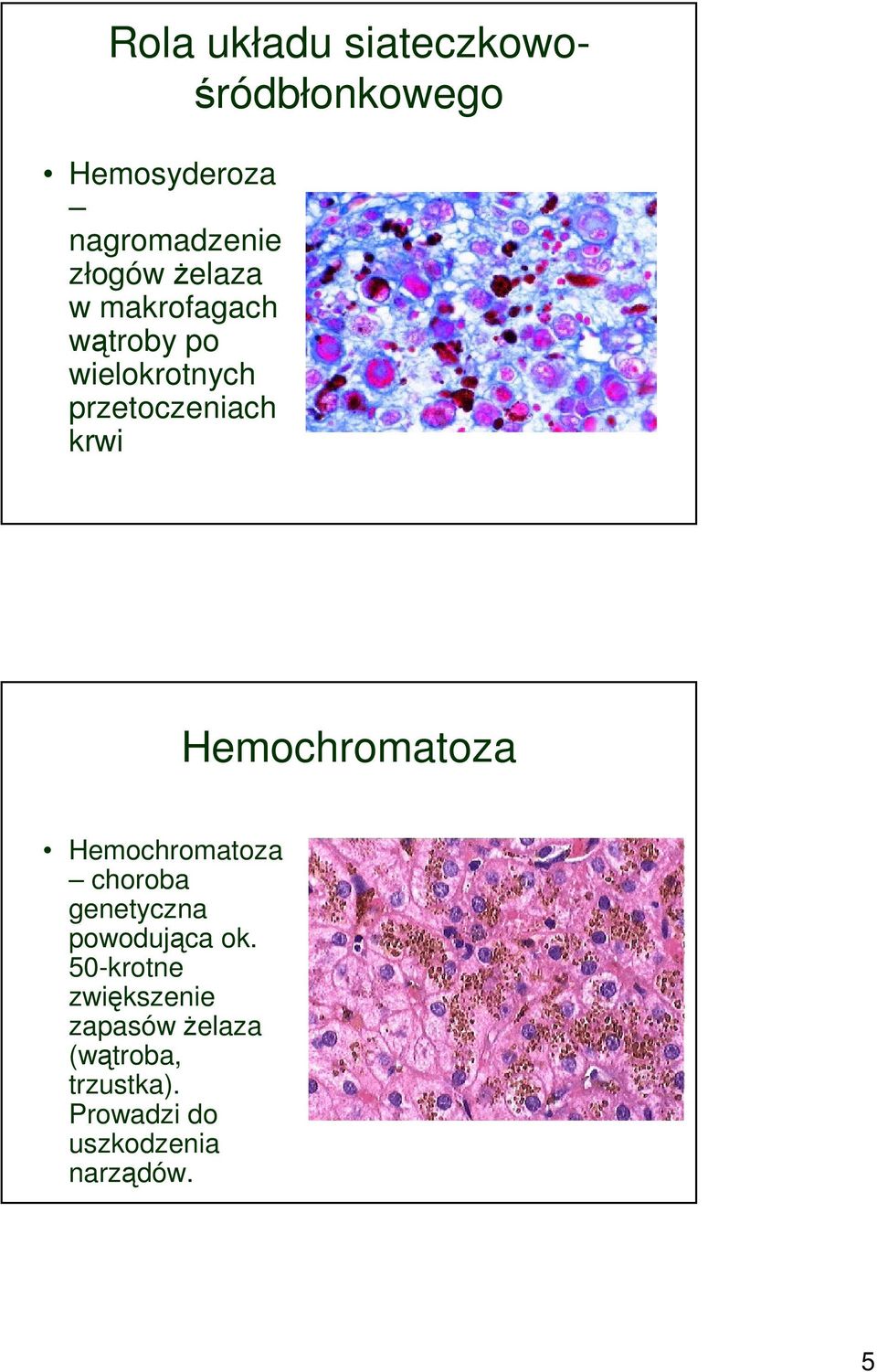 Hemochromatoza Hemochromatoza choroba genetyczna powodująca ok.