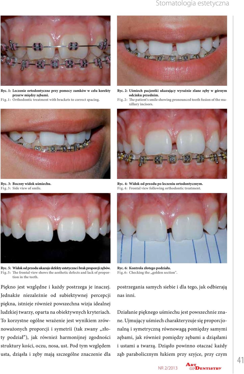 3: Side view of smile. Ryc. 4: Widok od przodu po leczeniu ortodontycznym. Fig.4: Frontal view following orthodontic treatment. Ryc. 5: Widok od przodu ukazuje defekty estetyczne i brak proporcji zębów.