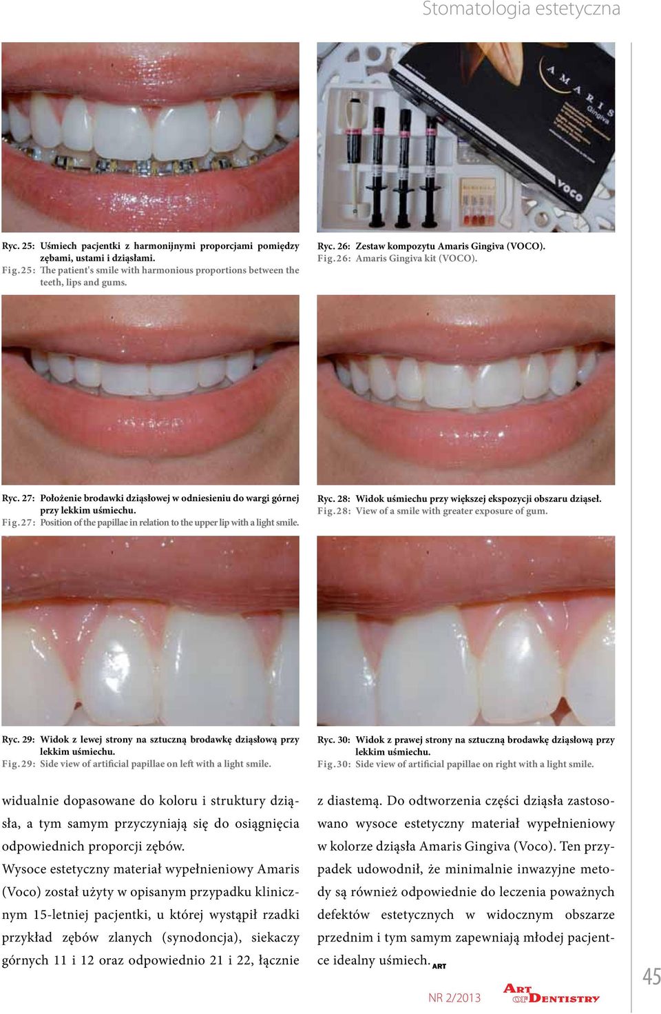 Position of the papillae in relation to the upper lip with a light smile. Ryc. 28: Widok uśmiechu przy większej ekspozycji obszaru dziąseł. Fig.28: View of a smile with greater exposure of gum. Ryc. 29: Fig.