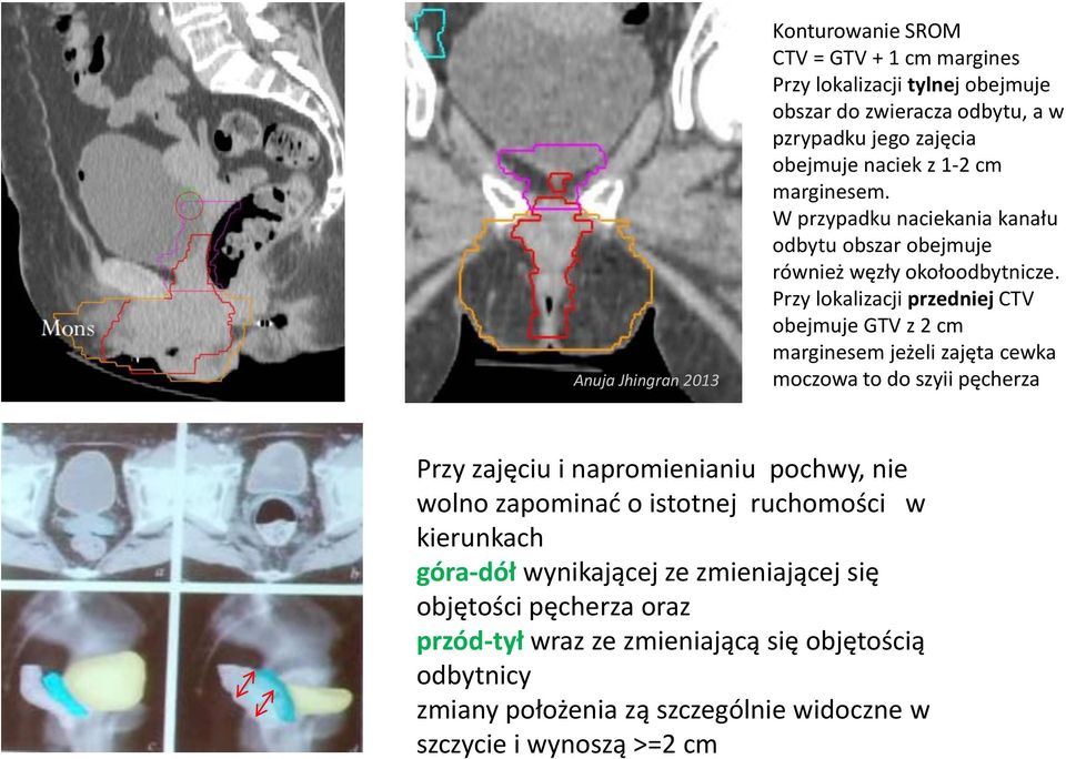 Przy lokalizacji przedniej CTV obejmuje GTV z 2 cm marginesem jeżeli zajęta cewka moczowa to do szyii pęcherza Przy zajęciu i napromienianiu pochwy, nie wolno