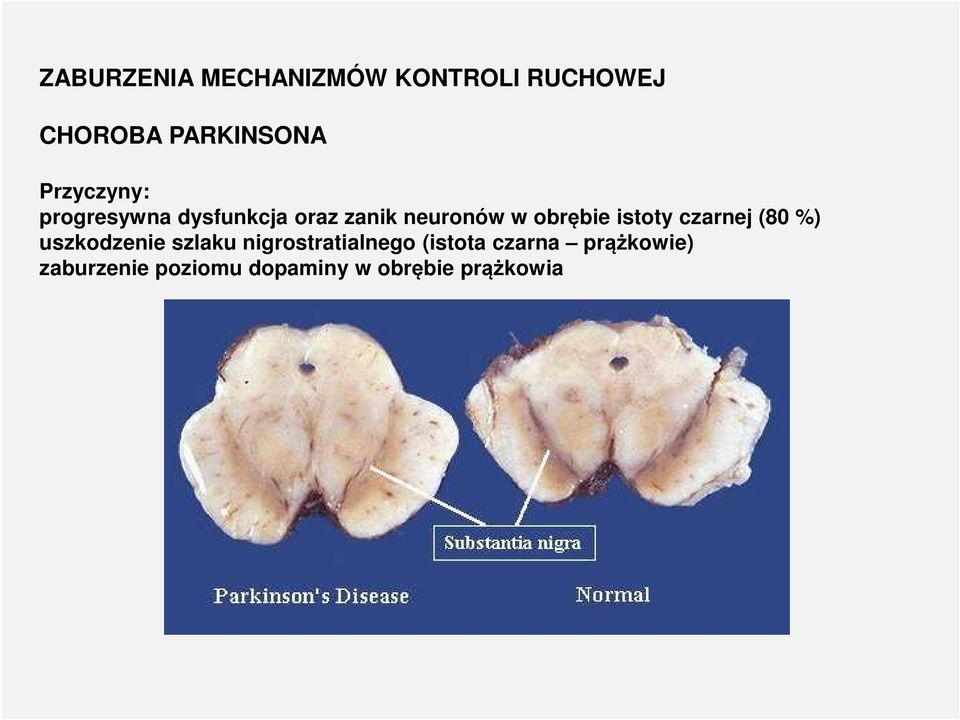 istoty czarnej (80 %) uszkodzenie szlaku nigrostratialnego