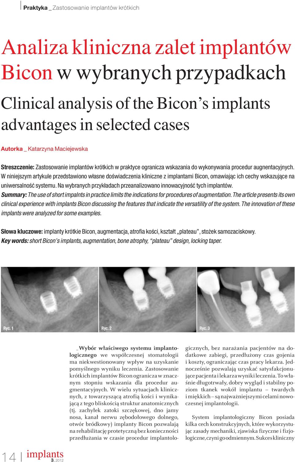 W niniejszym artykule przedstawiono własne doêwiadczenia kliniczne z implantami Bicon, omawiajàc ich cechy wskazujàce na uniwersalnoêç systemu.