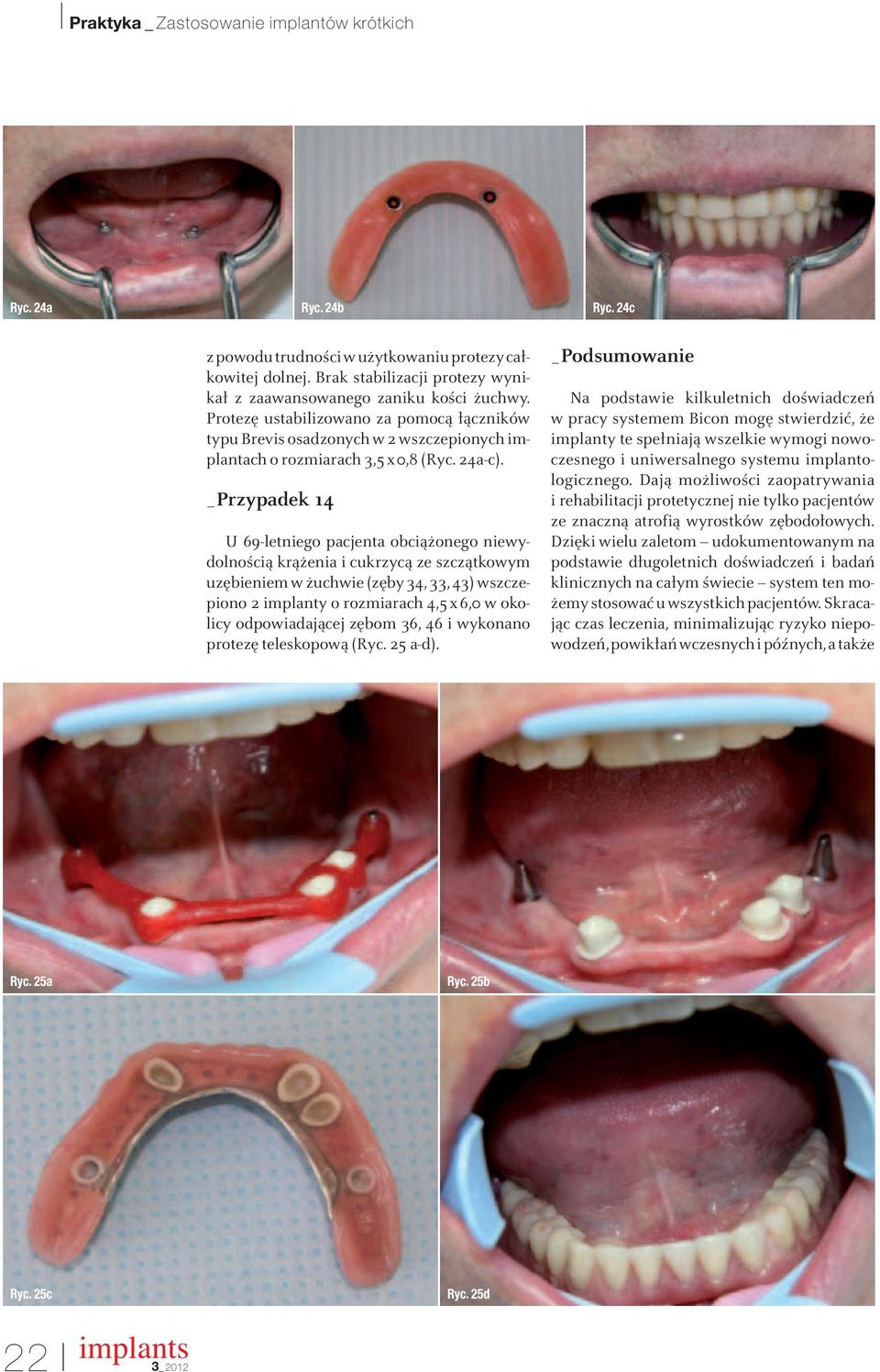 _Przypadek 14 U 69-letniego pacjenta obciążonego niewydolnością krążenia i cukrzycą ze szczątkowym uzębieniem w żuchwie (zęby 34, 33, 43) wszczepiono 2 implanty o rozmiarach 4,5x6,0 w okolicy