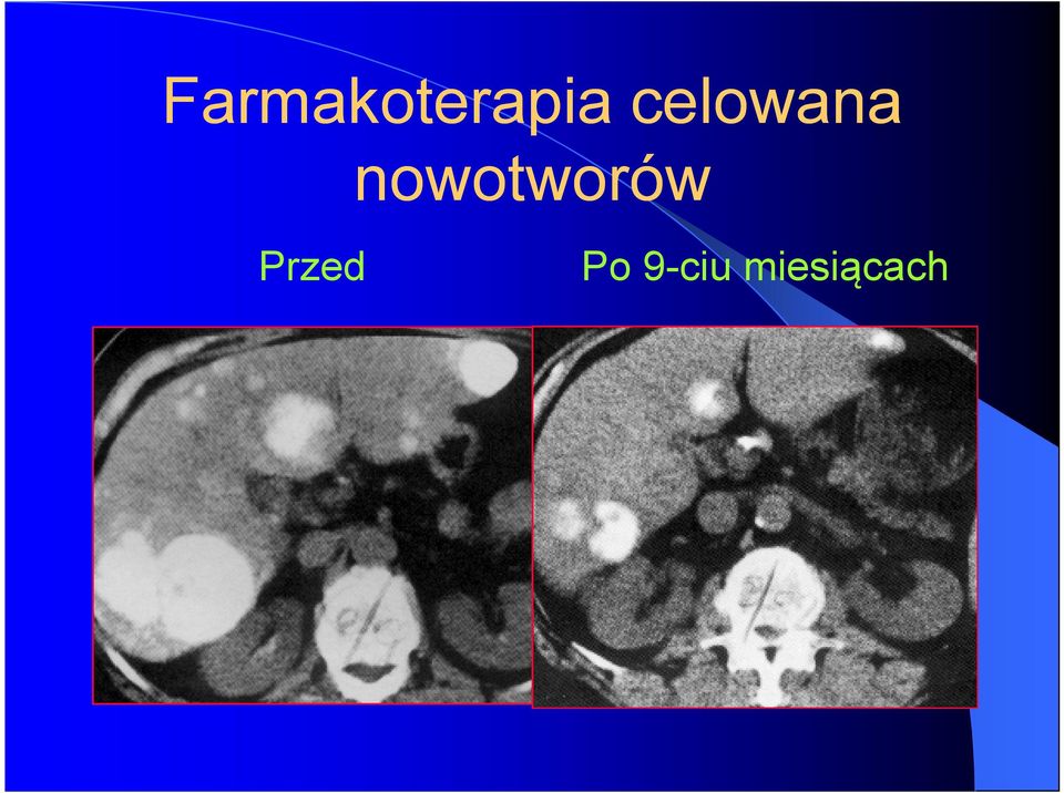 nowotworów