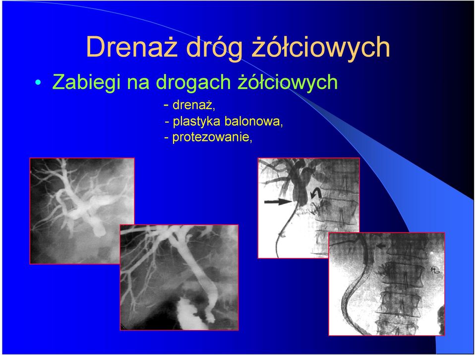 żółciowych - drenaż, -