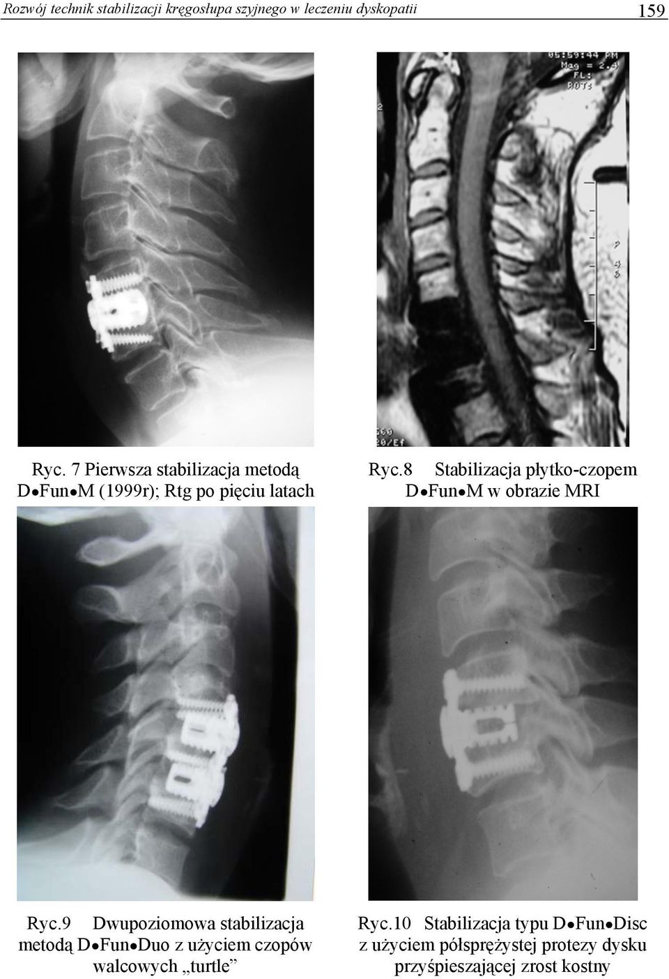 8 Stabilizacja płytko-czopem D Fun M w obrazie MRI Ryc.