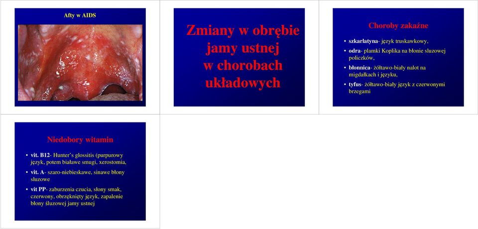 czerwonymi brzegami Niedobory witamin vit. B12- Hunter s glossitis (purpurowy język, potem białawe smugi, xerostomia, vit.