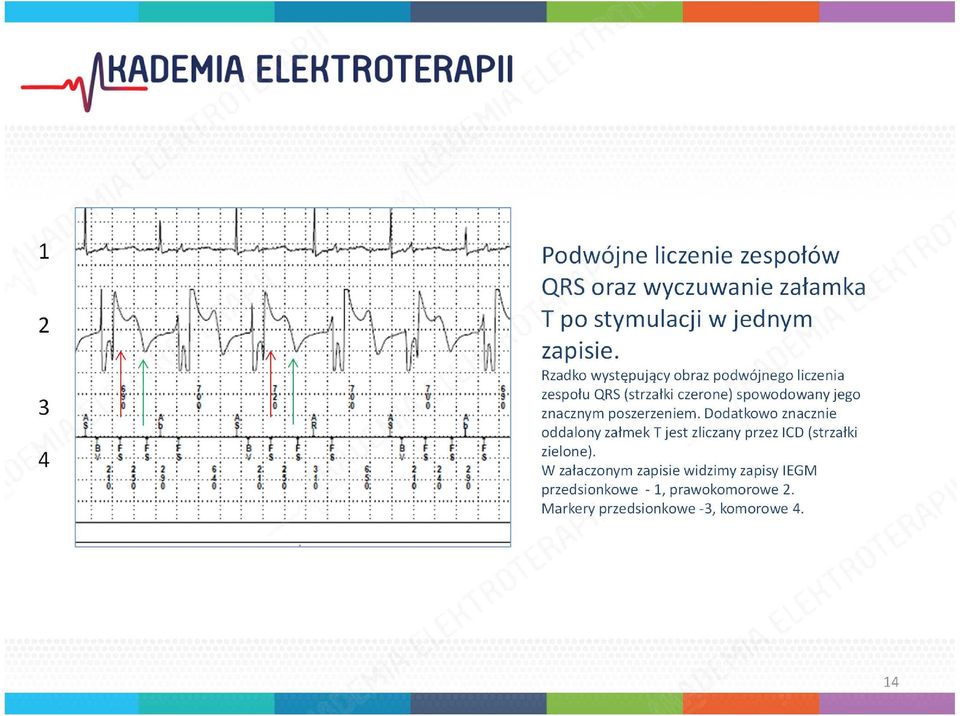 Rzadko występujący obraz podwójnego liczenia zespołu QRS (strzałki czerone) spowodowany jego znacznym poszerzeniem.