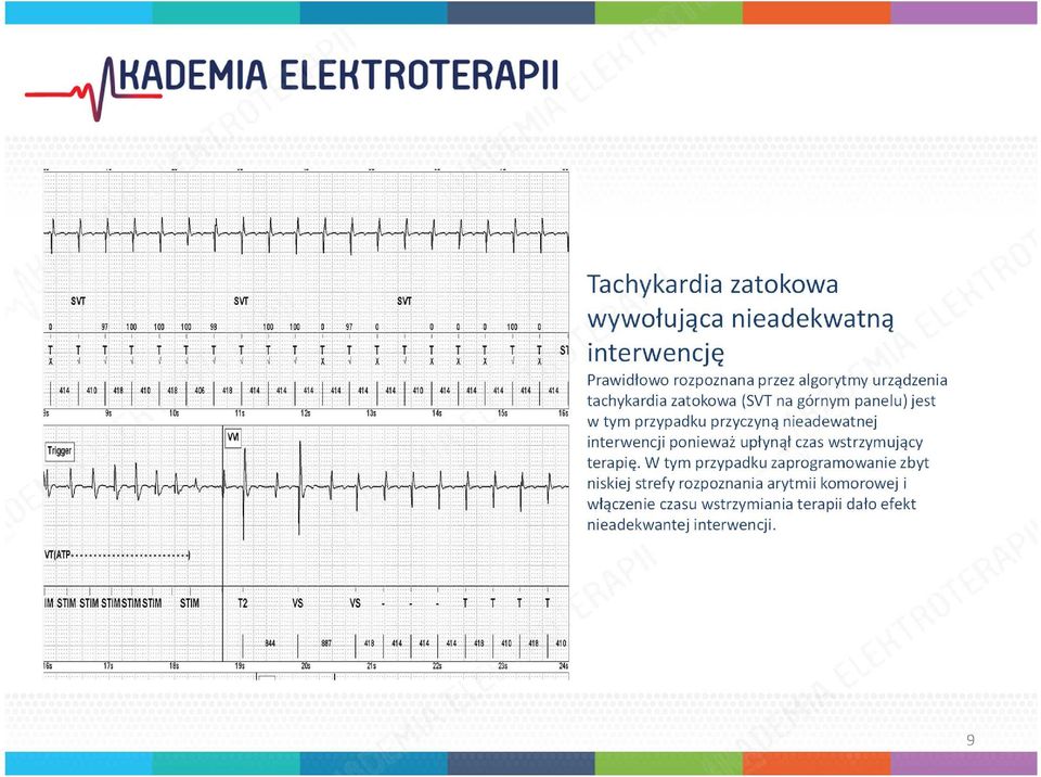 Prawidłowo rozpoznana przez algorytmy urządzenia tachykardia zatokowa (SVT na górnym panelu) jest w tym przypadku przyczyną nieadewatnej