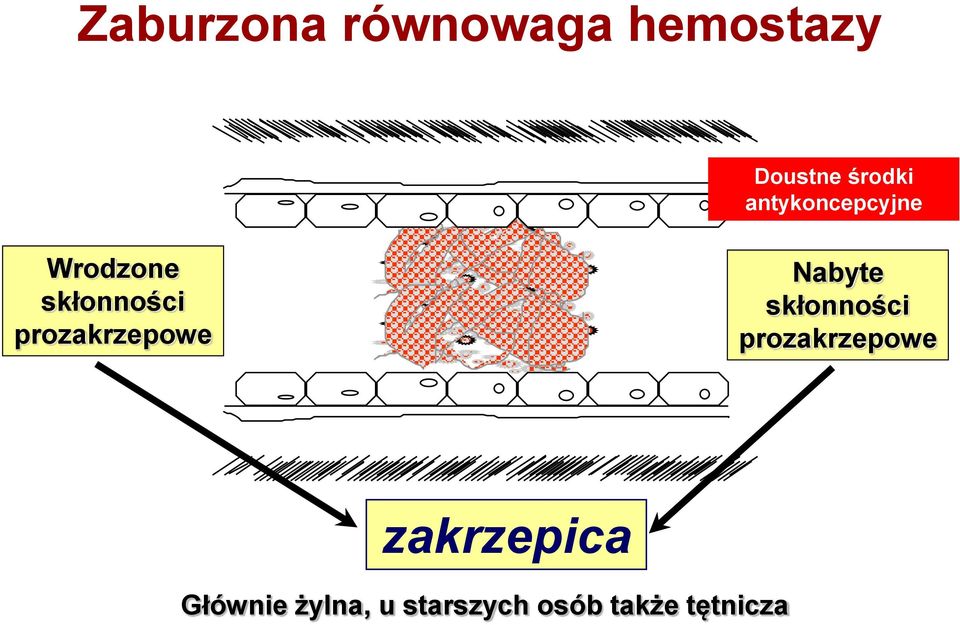 prozakrzepowe Nabyte skłonności prozakrzepowe