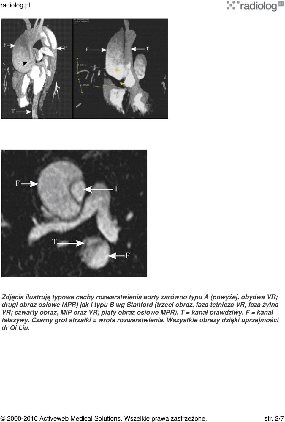 obraz osiowe MPR). T = kanał prawdziwy. F = kanał fałszywy. Czarny grot strzałki = wrota rozwarstwienia.