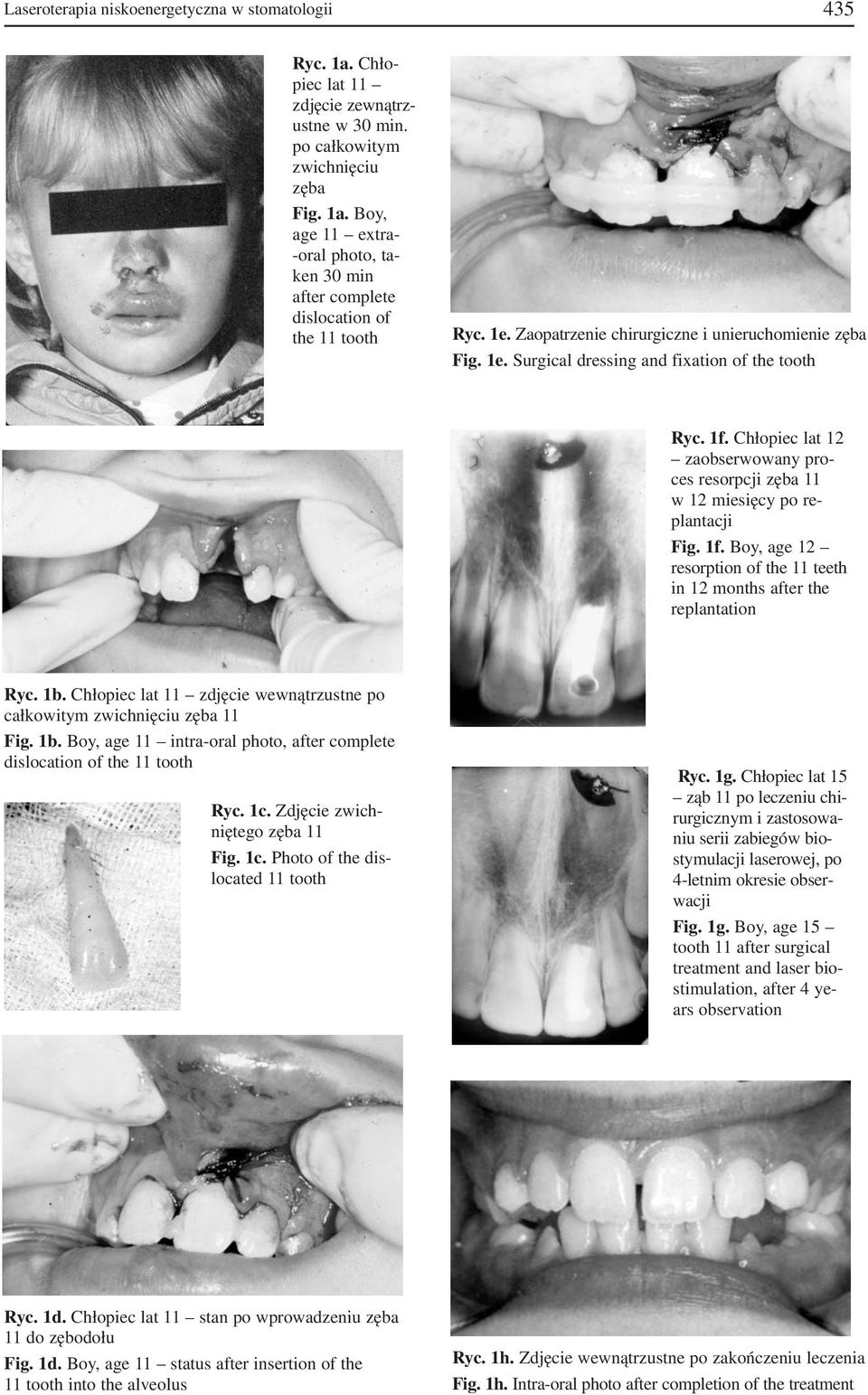 Chłopiec lat 12 zaobserwowany pro ces resorpcji zęba 11 w 12 miesięcy po re plantacji Fig. 1f. Boy, age 12 resorption of the 11 teeth in 12 months after the replantation Ryc. 1b.