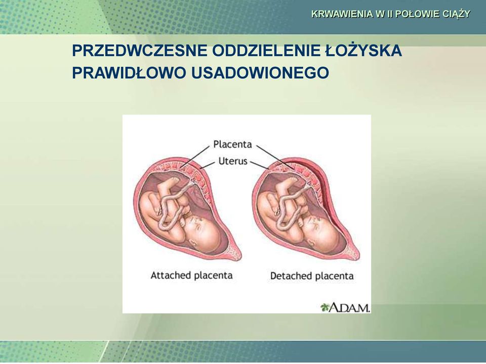 KRWAWIENIA W II POŁOWIE CIĄŻY KRWAWIENIA W II POŁOWIE CIĄŻY - PDF Free  Download