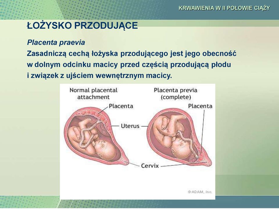 KRWAWIENIA W II POŁOWIE CIĄŻY KRWAWIENIA W II POŁOWIE CIĄŻY - PDF Free  Download