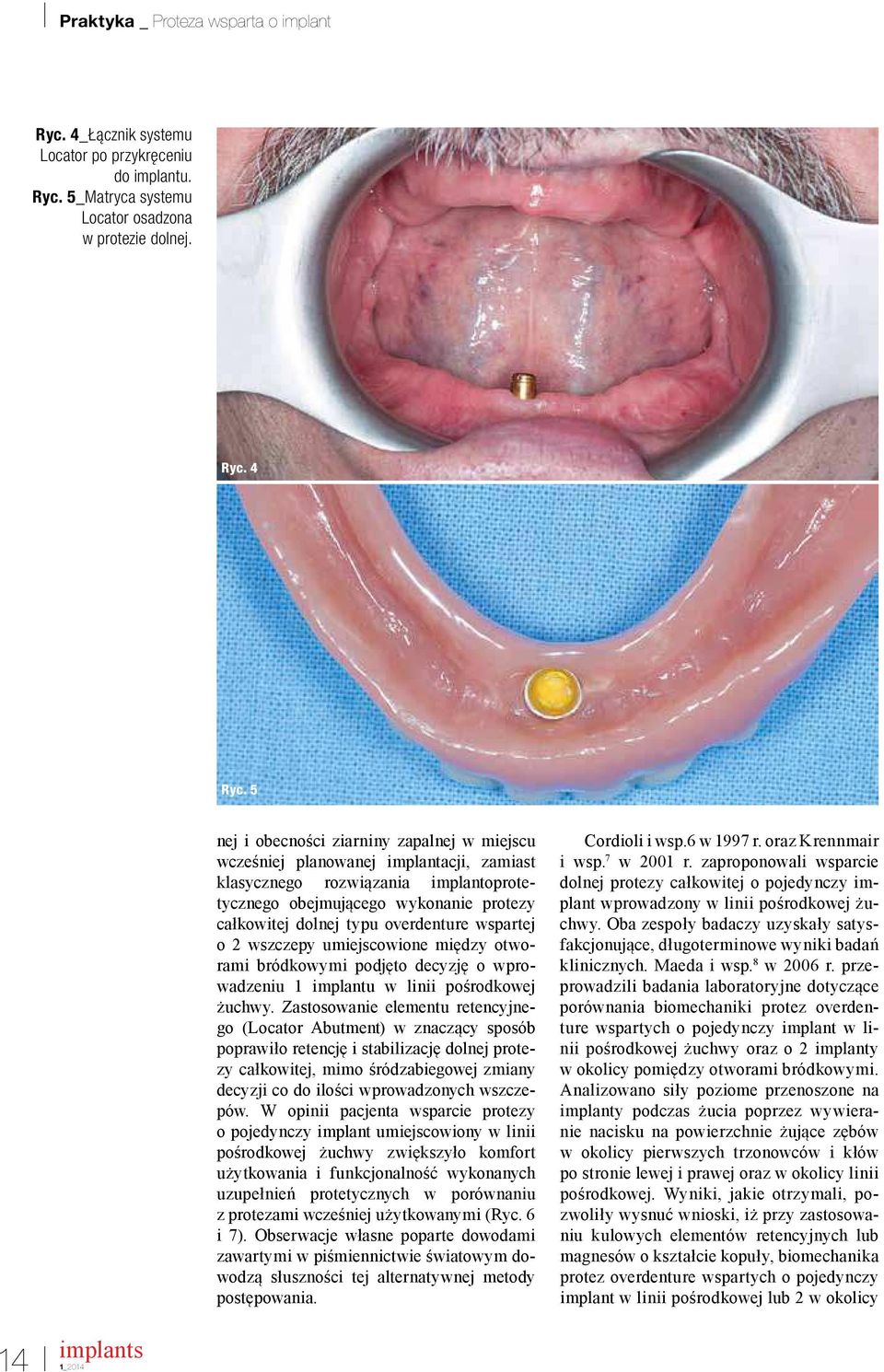 wspartej o 2 wszczepy umiejscowione między otworami bródkowymi podjęto decyzję o wprowadzeniu 1 implantu w linii pośrodkowej żuchwy.