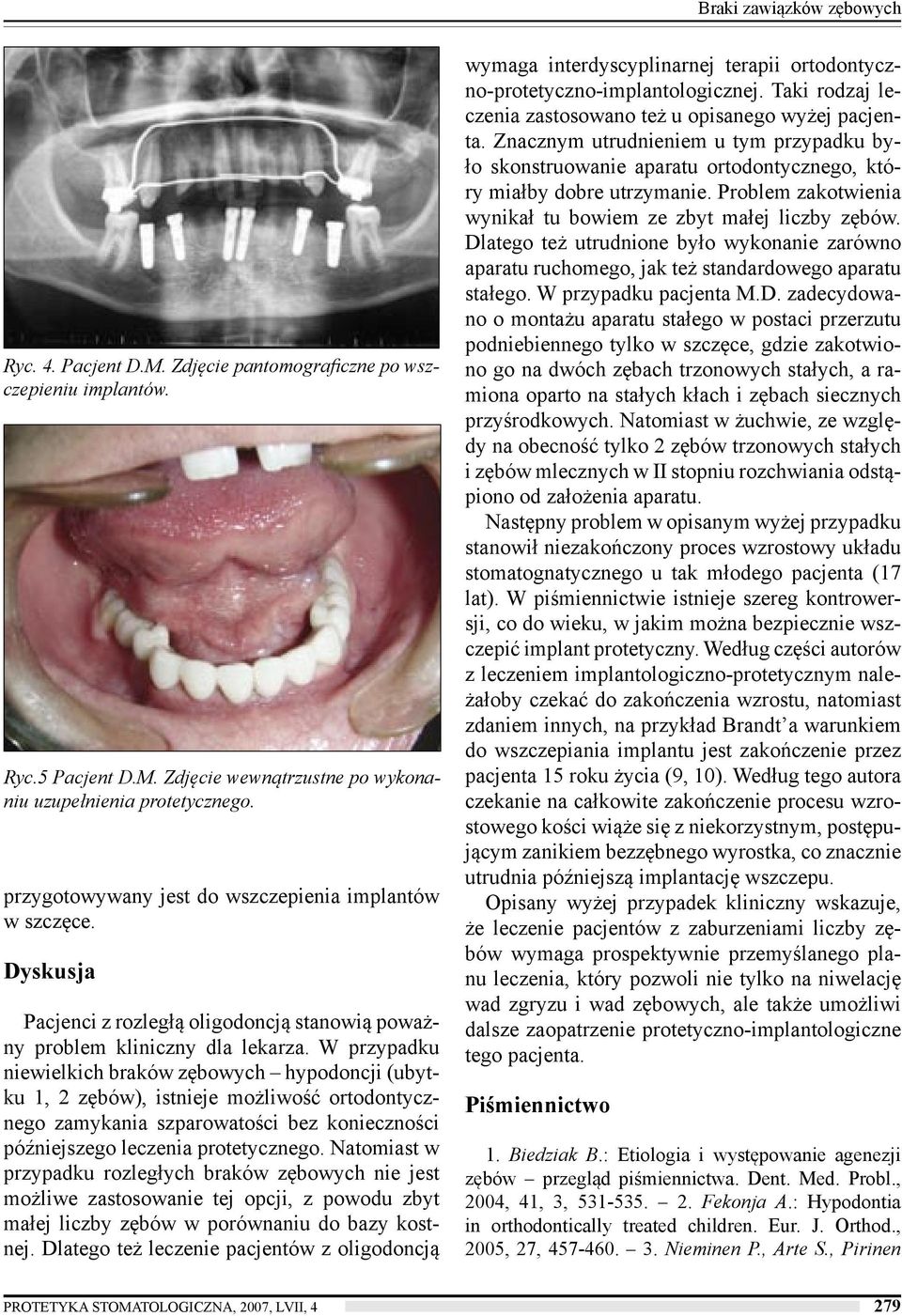 W przypadku niewielkich braków zębowych hypodoncji (ubytku 1, 2 zębów), istnieje możliwość ortodontycznego zamykania szparowatości bez konieczności późniejszego leczenia protetycznego.