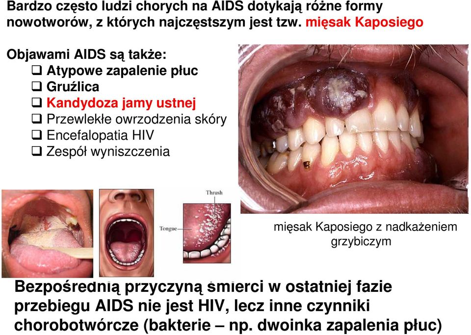 owrzodzenia skóry Encefalopatia HIV Zespół wyniszczenia mięsak Kaposiego z nadkaŝeniem grzybiczym Bezpośrednią