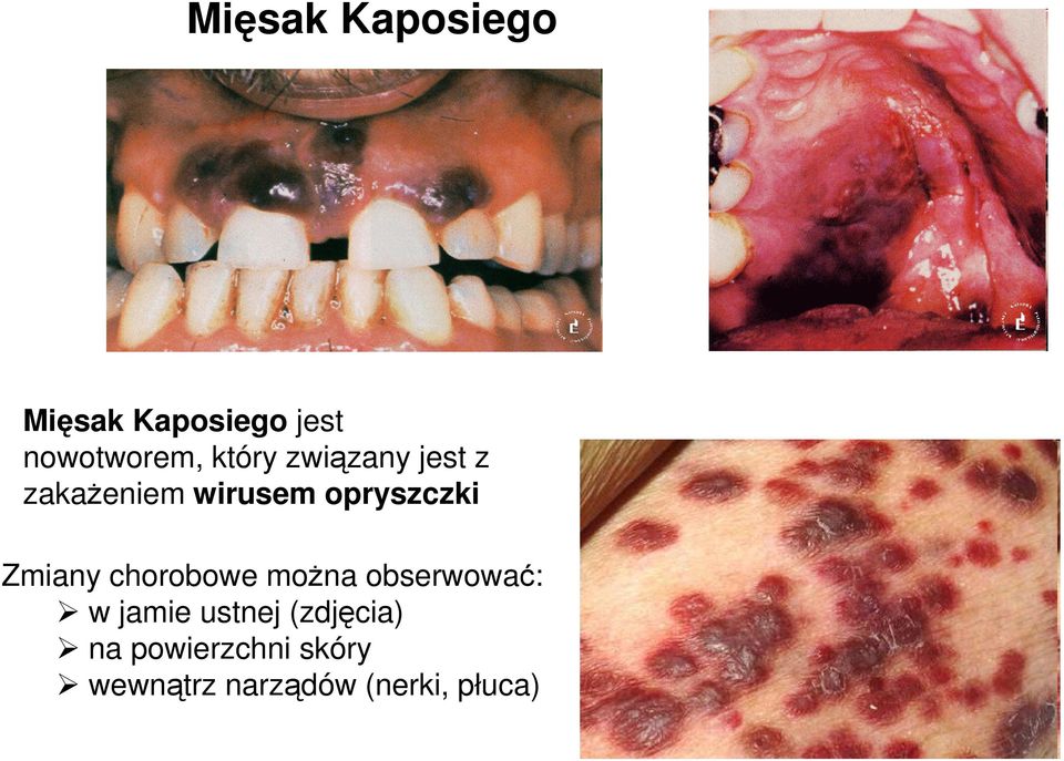 Zmiany chorobowe moŝna obserwować: w jamie ustnej