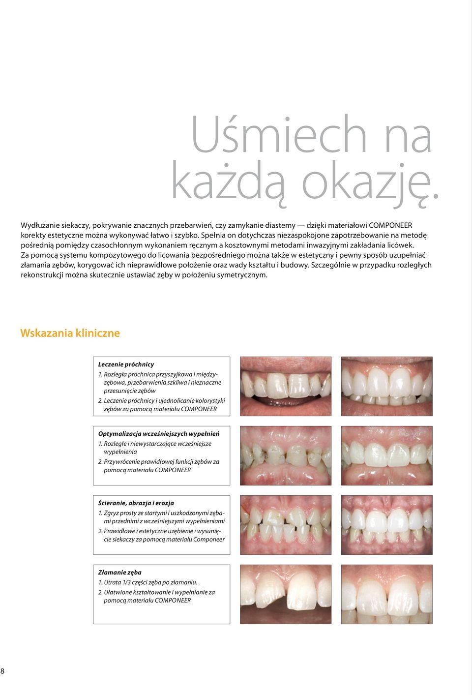 Za pomocą systemu kompozytowego do licowania bezpośredniego można także w estetyczny i pewny sposób uzupełniać złamania zębów, korygować ich nieprawidłowe położenie oraz wady kształtu i budowy.