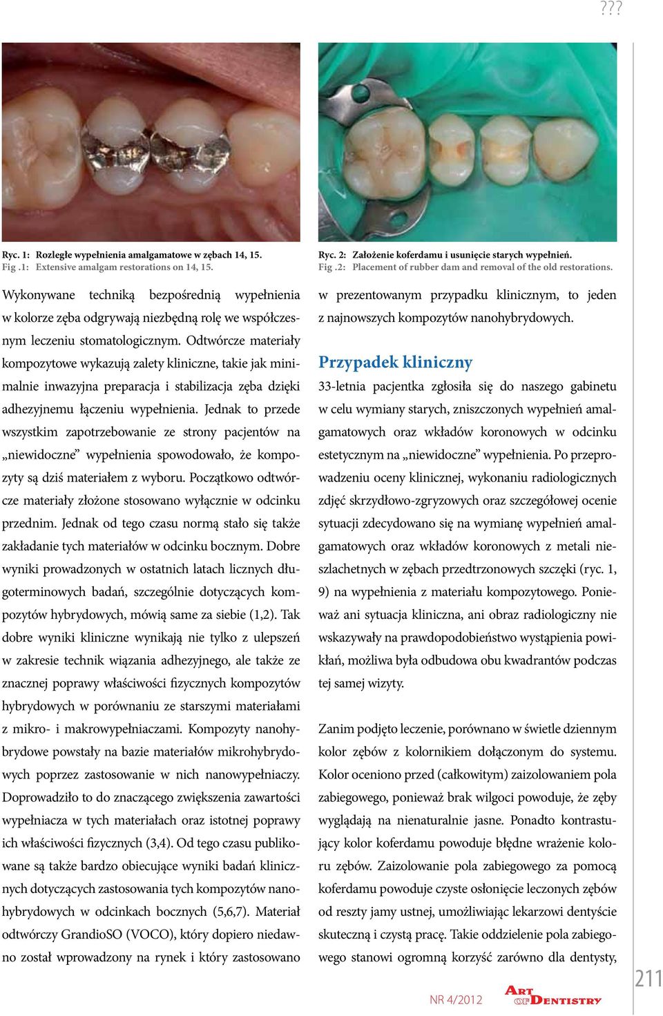 Odtwórcze materiały kompozytowe wykazują zalety kliniczne, takie jak minimalnie inwazyjna preparacja i stabilizacja zęba dzięki adhezyjnemu łączeniu wypełnienia.