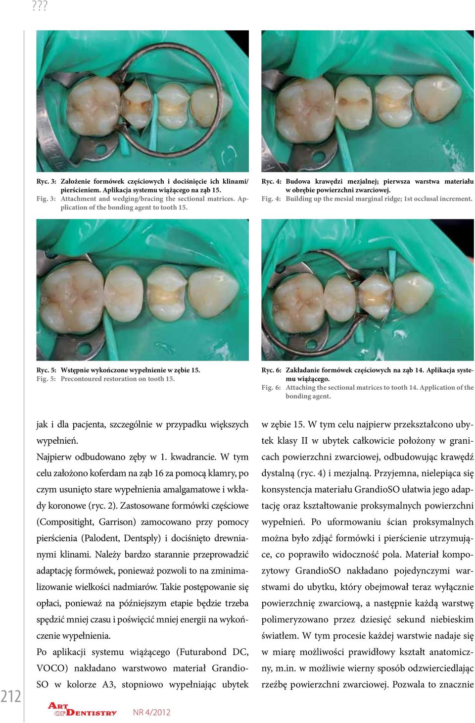 Building up the mesial marginal ridge; 1st occlusal increment. Ryc. 5: Fig. 5: Wstępnie wykończone wypełnienie w zębie 15. Precontoured restoration on tooth 15. Ryc. 6: Fig.