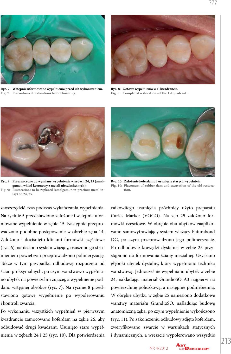 Restorations to be replaced (amalgam, non-precious metal inlay) on 24, 25. Ryc. 10: Założenie koferdamu i usunięcie starych wypełnień. Fig.