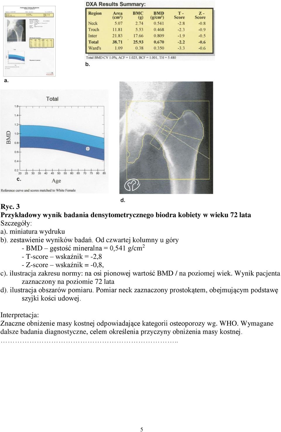 ilustracja zakresu normy: na osi pionowej wartość BMD / na poziomej wiek. Wynik pacjenta zaznaczony na poziomie 72 lata d). ilustracja obszarów pomiaru.