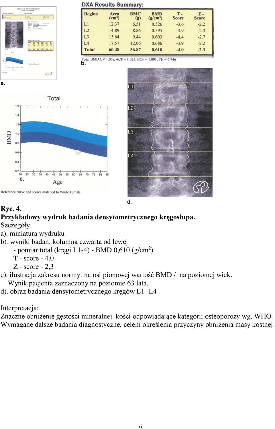 ilustracja zakresu normy: na osi pionowej wartość BMD / na poziomej wiek. Wynik pacjenta zaznaczony na poziomie 63 lata. d).