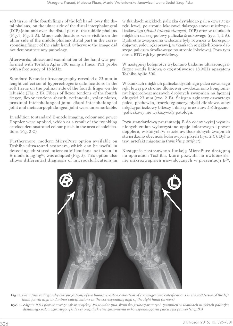 Minor calcifications were visible on the ulnar side of the middle phalanx distal part in the corresponding finger of the right hand. Otherwise the image did not demonstrate any pathology.