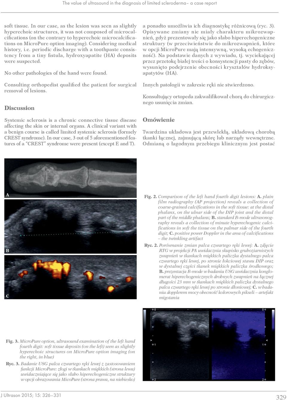 Considering medical history, i.e. periodic discharge with a toothpaste consistency from a tiny fistula, hydroxyapatite (HA) deposits were suspected. No other pathologies of the hand were found.