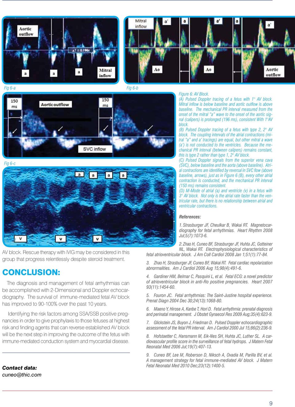 (B) Pulsed Doppler tracing of a fetus with type 2, 2 AV block.
