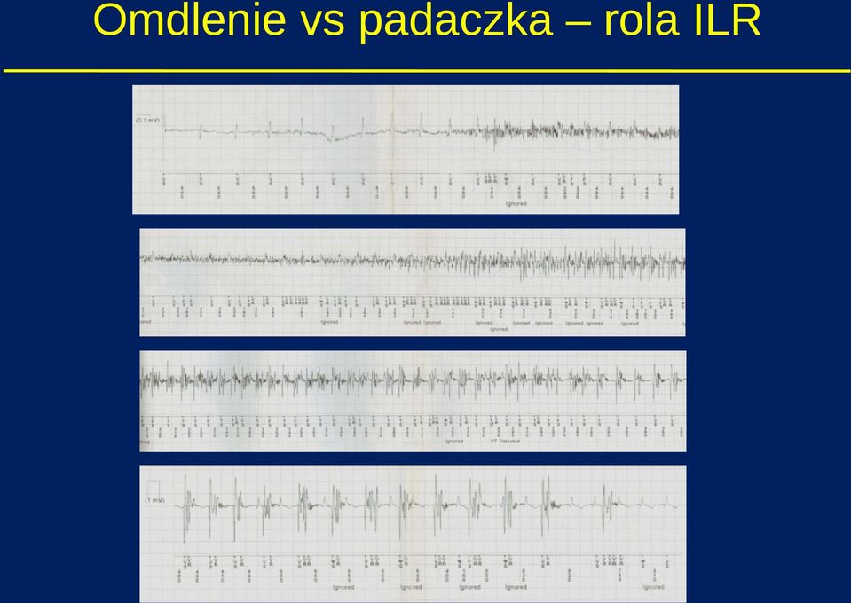 padaczka