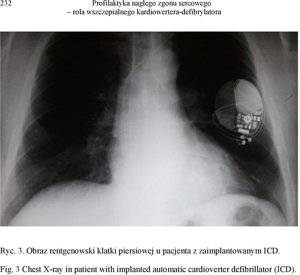 pacjenta z zaimplantowanym ICD. Fig.