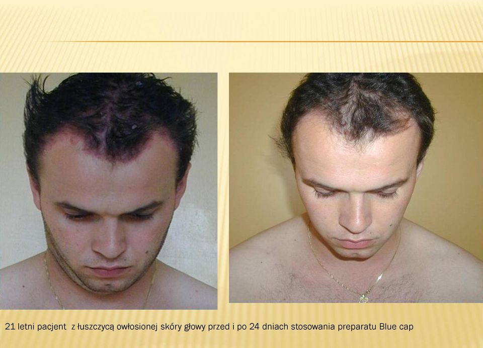 skóry głowy przed i po 24