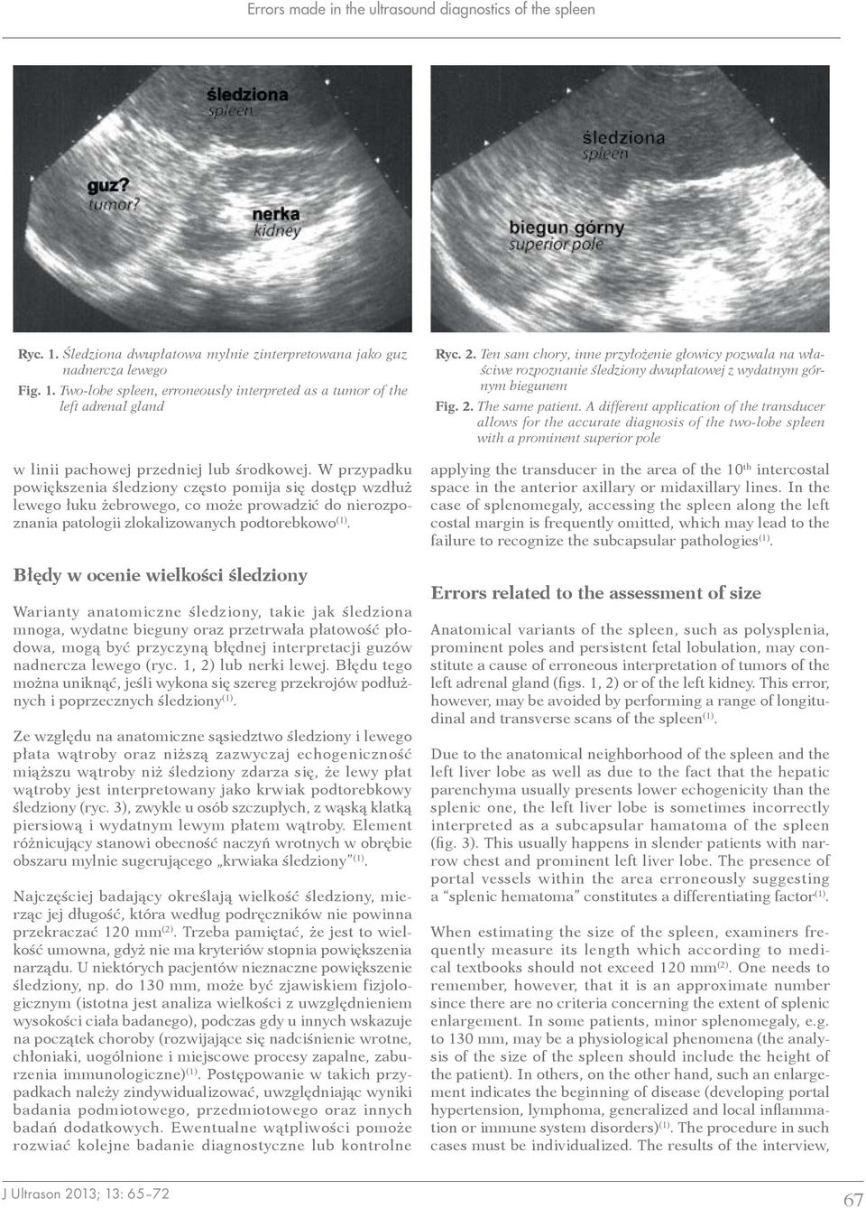 Błędy w ocenie wielkości śledziony Warianty anatomiczne śledziony, takie jak śledziona mnoga, wydatne bieguny oraz przetrwała płatowość płodowa, mogą być przyczyną błędnej interpretacji guzów