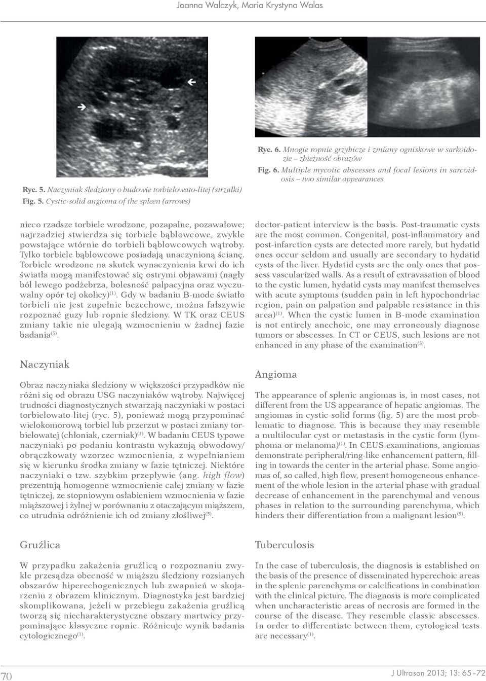 Multiple mycotic abscesses and focal lesions in sarcoidosis two similar appearances nieco rzadsze torbiele wrodzone, pozapalne, pozawałowe; najrzadziej stwierdza się torbiele bąblowcowe, zwykle