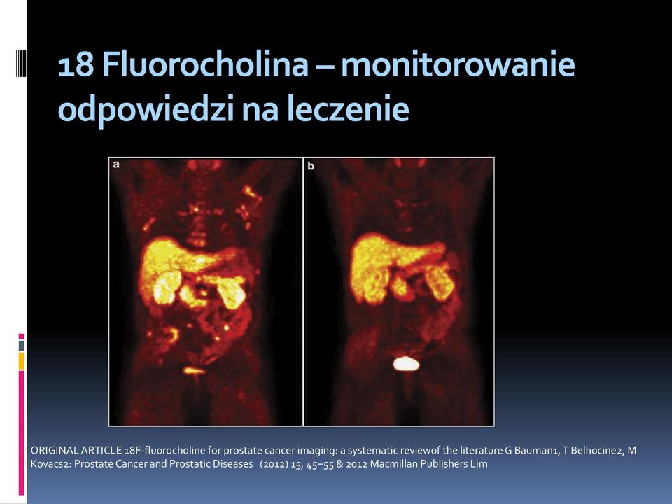 reviewof the literature G Bauman1, T Belhocine2, M Kovacs2: Prostate