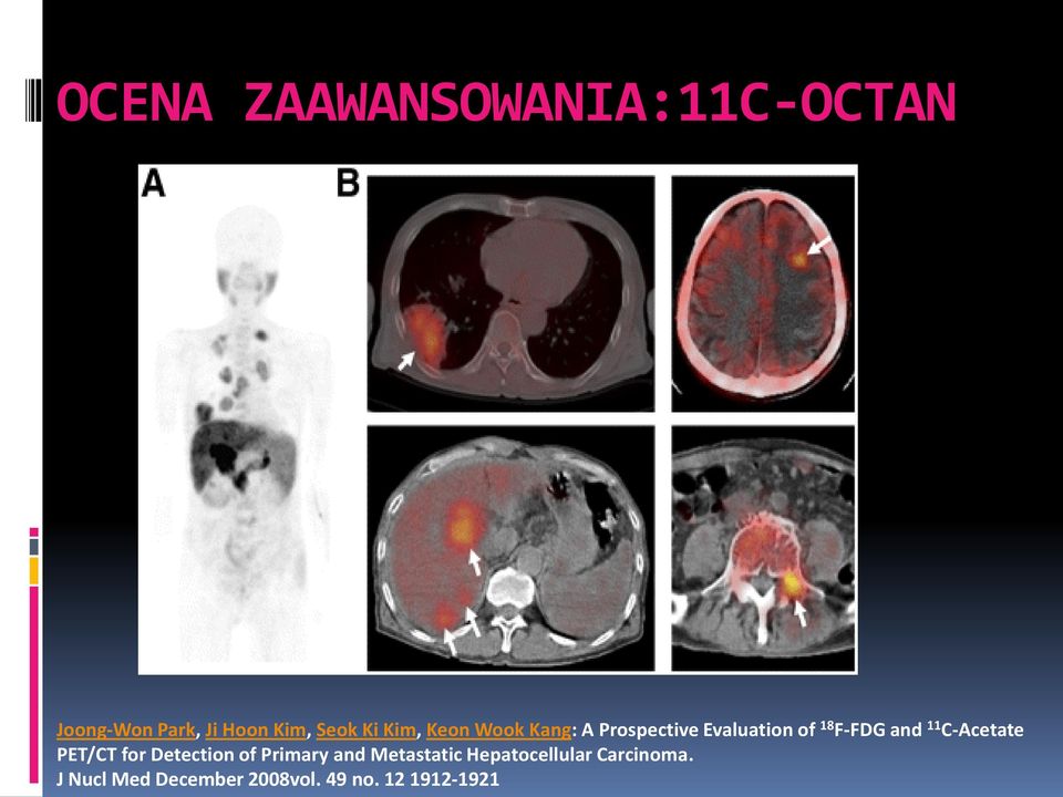 11 C-Acetate PET/CT for Detection of Primary and Metastatic