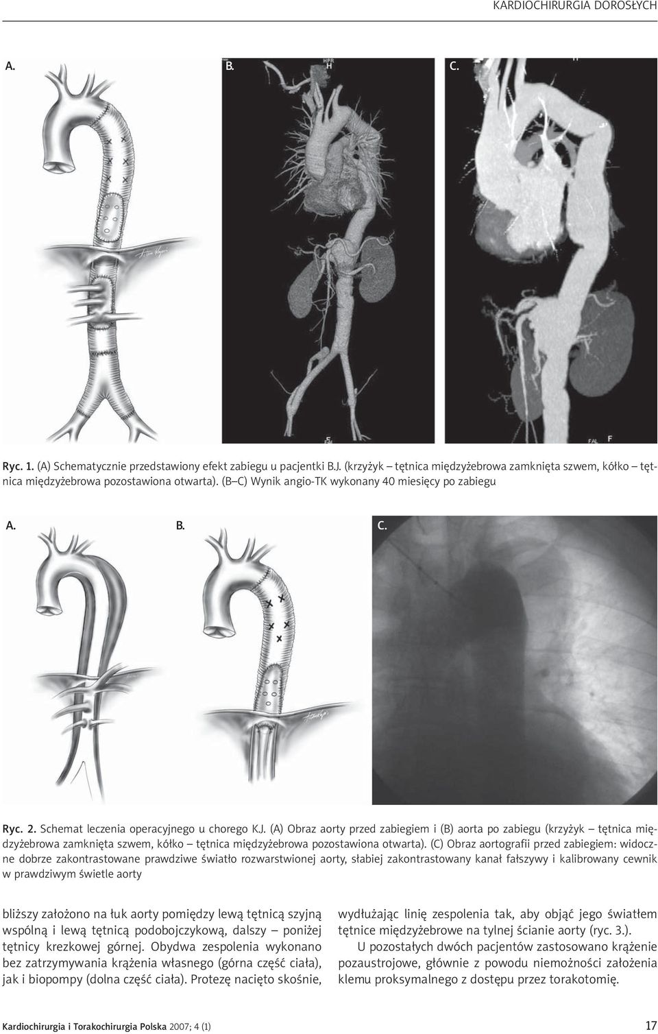 (A) Obraz aorty przed zabiegiem i (B) aorta po zabiegu (krzy yk têtnica miêdzy ebrowa zamkniêta szwem, kó³ko têtnica miêdzy ebrowa pozostawiona otwarta).