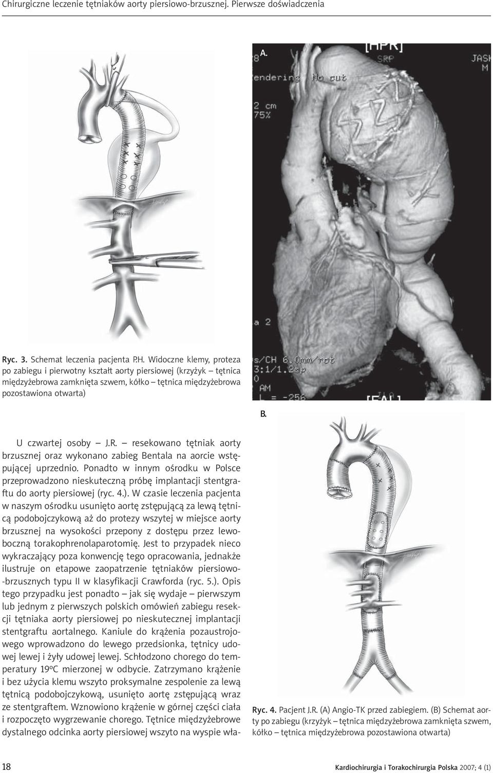 resekowano têtniak aorty brzusznej oraz wykonano zabieg Bentala na aorcie wstêpuj¹cej uprzednio.