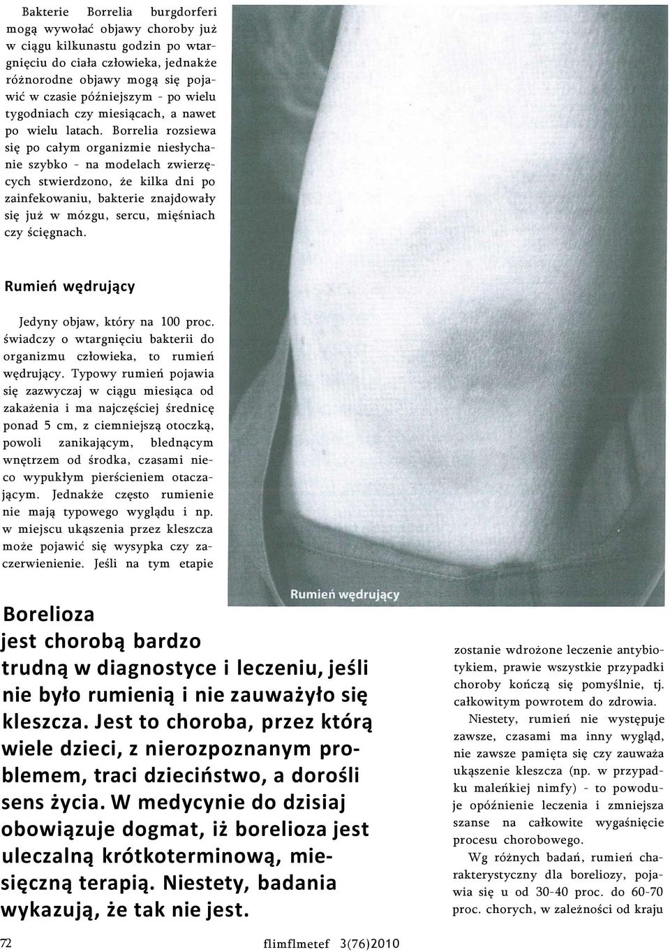 Borrelia rozsiewa się po całym organizmie niesłychanie szybko - na modelach zwierzęcych stwierdzono, że kilka dni po zainfekowaniu, bakterie znajdowały się już w mózgu, sercu, mięśniach czy ścięgnach.