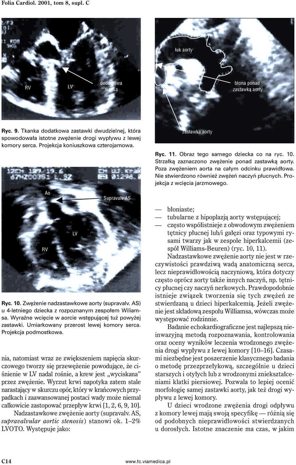 Zwężenie nadzastawkowe aorty (supravalv. AS) u 4-letniego dziecka z rozpoznanym zespołem Wiliamsa. Wyraźne wcięcie w aorcie wstępującej tuż powyżej zastawki. Umiarkowany przerost lewej komory serca.