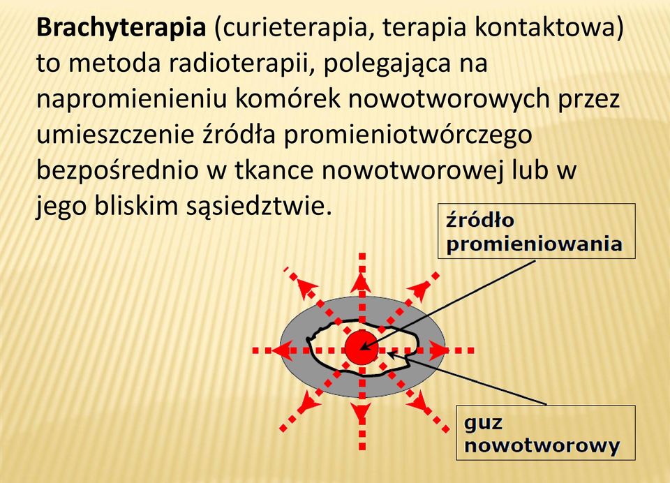 nowotworowych przez umieszczenie źródła promieniotwórczego