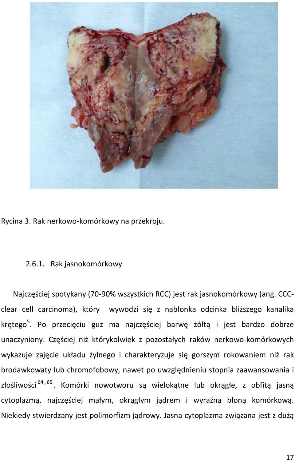 Częściej niż którykolwiek z pozostałych raków nerkowo-komórkowych wykazuje zajęcie układu żylnego i charakteryzuje się gorszym rokowaniem niż rak brodawkowaty lub chromofobowy, nawet po