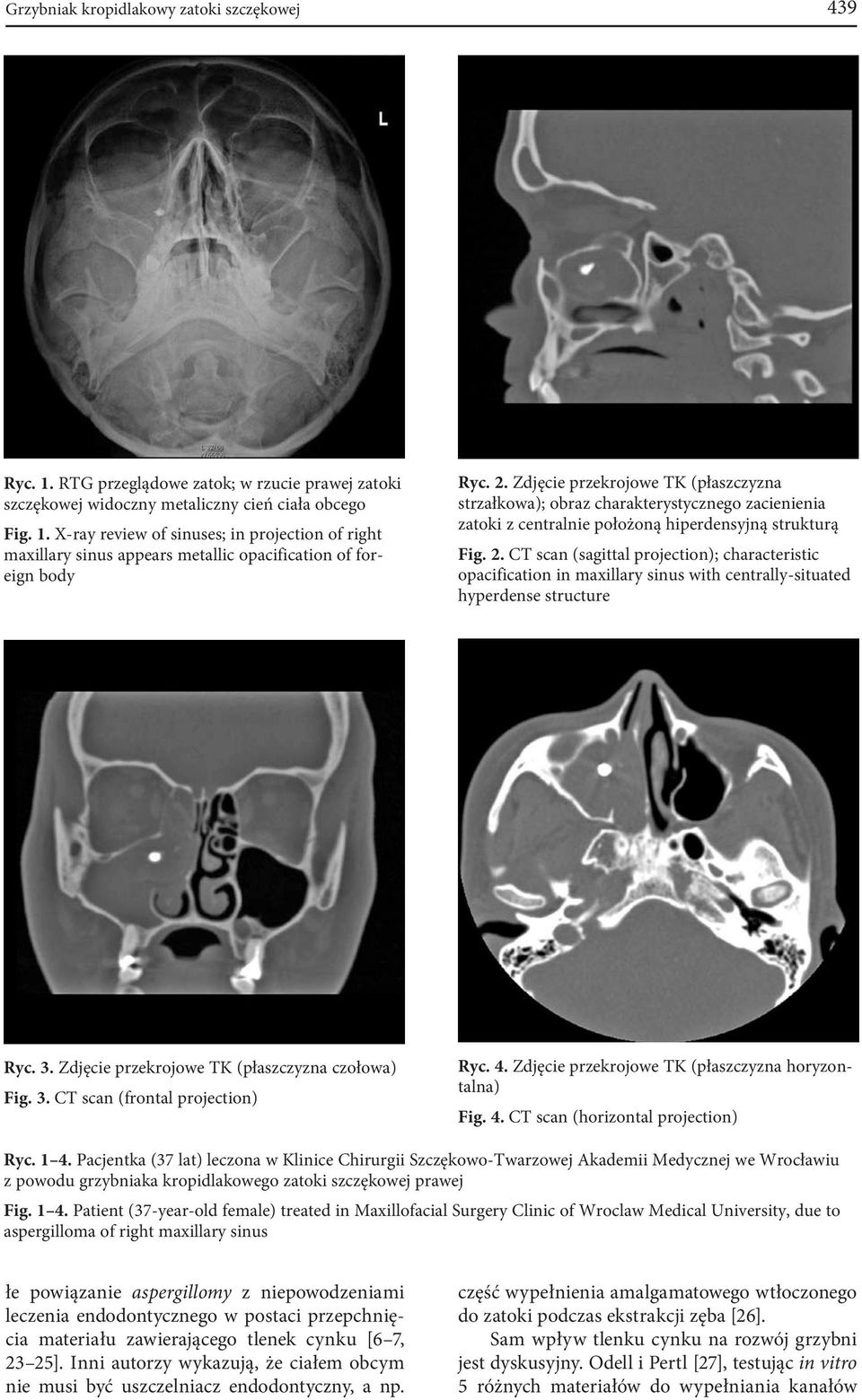 CT scan (sagittal projection); characteristic opacification in maxillary sinus with centrally-situated hyperdense structure Ryc. 3. Zdjęcie przekrojowe TK (płaszczyzna czołowa) Fig. 3. CT scan (frontal projection) Ryc.