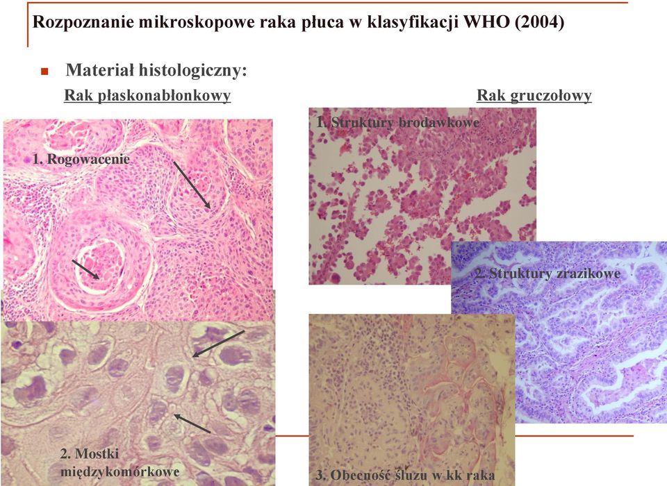 gruczołowy 1. Struktury brodawkowe 1. Rogowacenie 2.