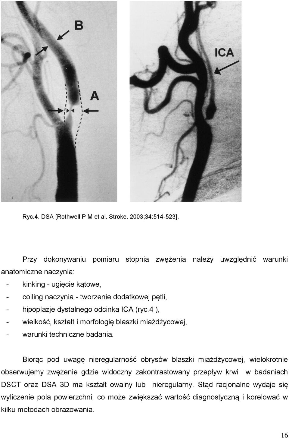 hipoplazje dystalnego odcinka ICA (ryc.4 ), - wielkość, kształt i morfologię blaszki miażdżycowej, - warunki techniczne badania.